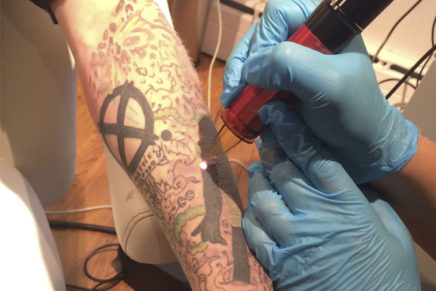 Tattoo regret and what to do about it